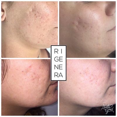 needling microoneedling roma trattamento estetico acne e cicatrici, rughe e macchie
