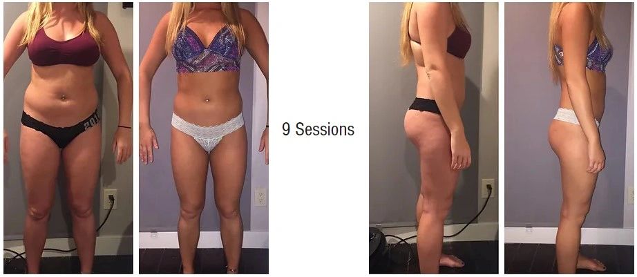 GLP-1 Weight Loss Support & Body Contouring Benefits GLP-1 Weight Loss Support & Body Contouring Benefits