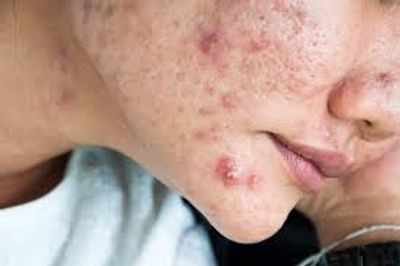 Acne Treatment