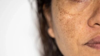 Close-up of facial skin with pigmentation.