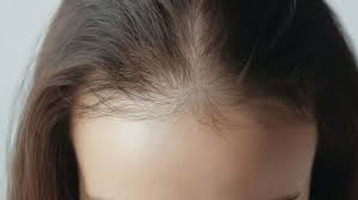 Hair Loss