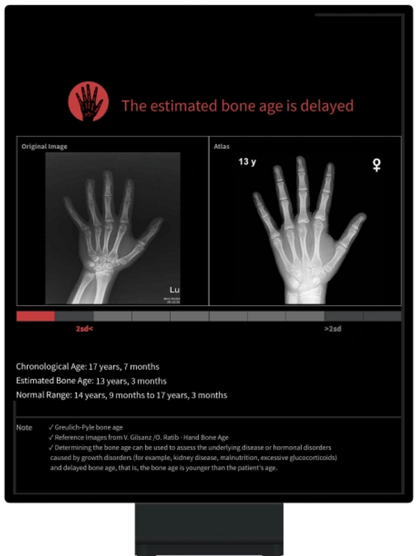 Computer-Aided Bone Age Diagnosis System
