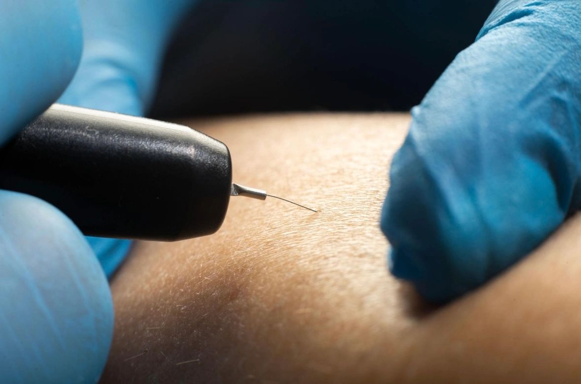 Close-up of a needle poised to pierce skin, held by gloved hands.