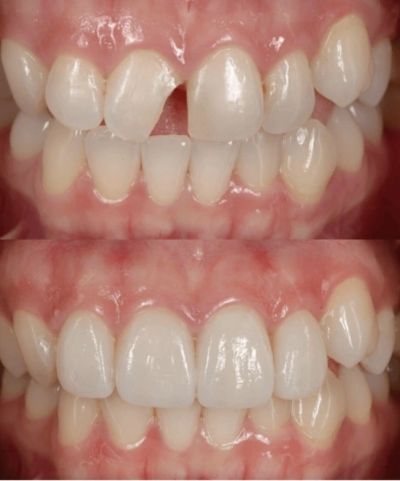 Before and after dental restoration showing improved teeth alignment and appearance.