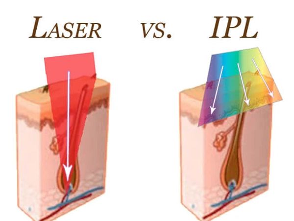 Comparison of laser and IPL hair removal targeting hair follicles.