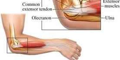 Diagram of elbow anatomy showing tennis elbow pain area treated by Sports Chiropractic in Pompano Be