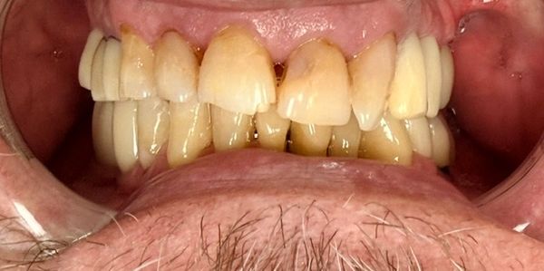 Close-up of discolored, crowded teeth with gum recession.