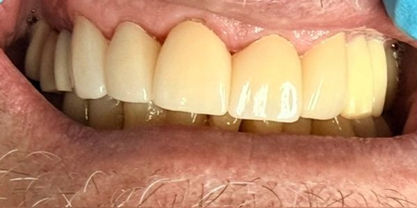 Close-up of a human mouth with yellowed teeth.