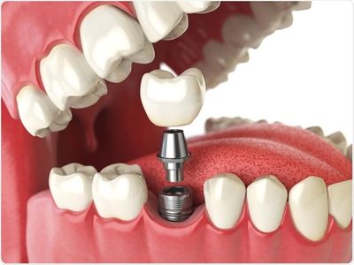 Costs For Dental Implants Arlington Texas