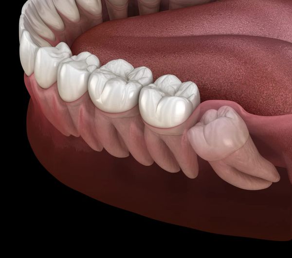 wisdom teeth removal in Arlington tx