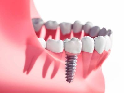 A illustration showing a single-tooth dental implant in Arlington, TX