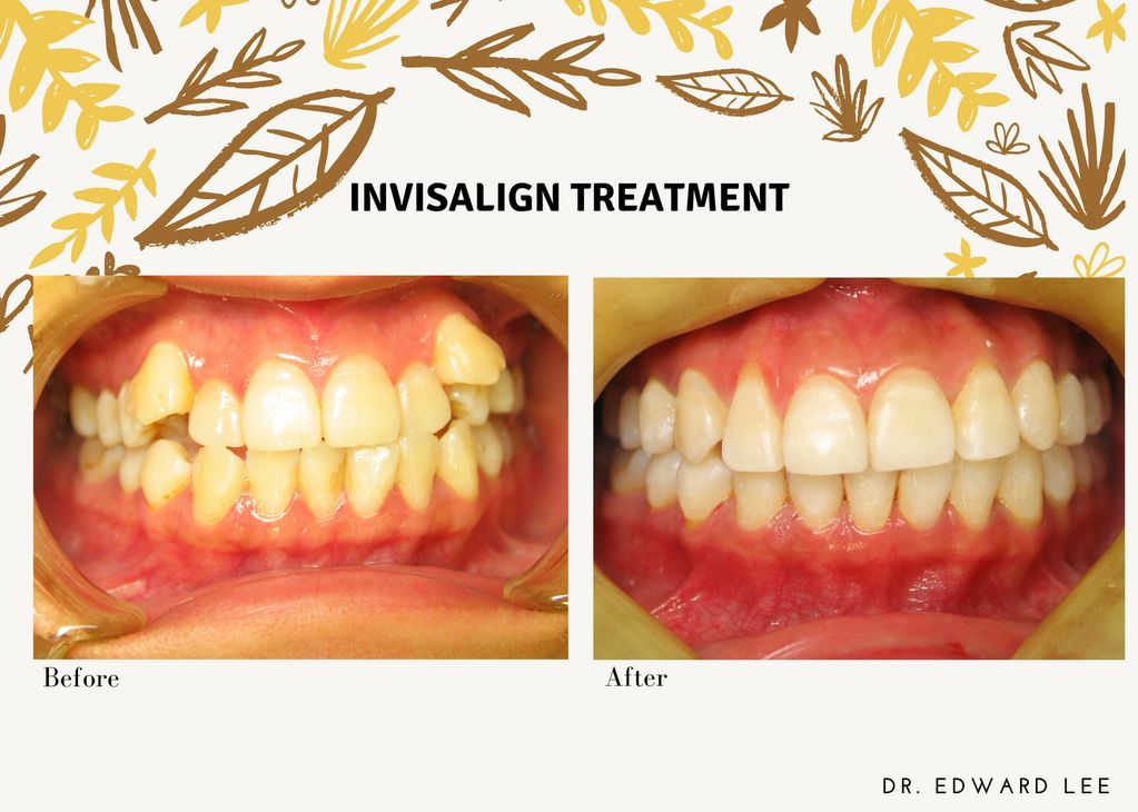 After before Invisalign treatment of teeth