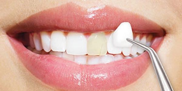 A woman teeth after and before Veneers