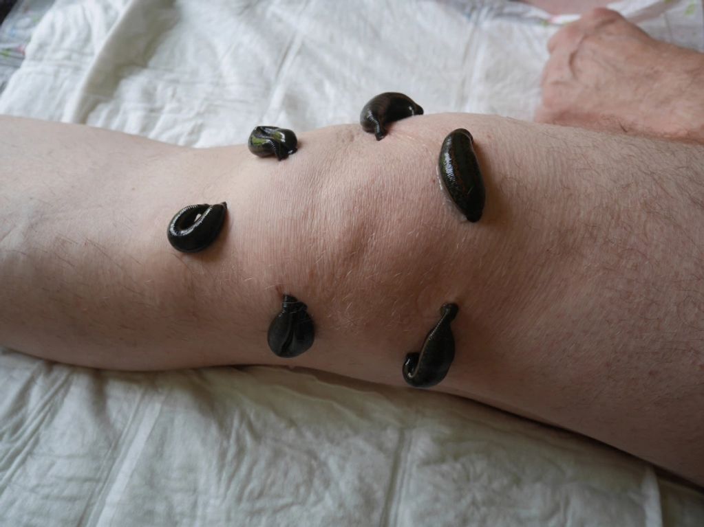 Medicinal Leeches Applied for knee Pain