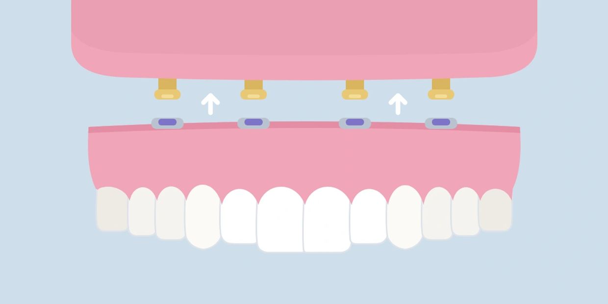 Illustration showing attachment of dental prosthesis.
