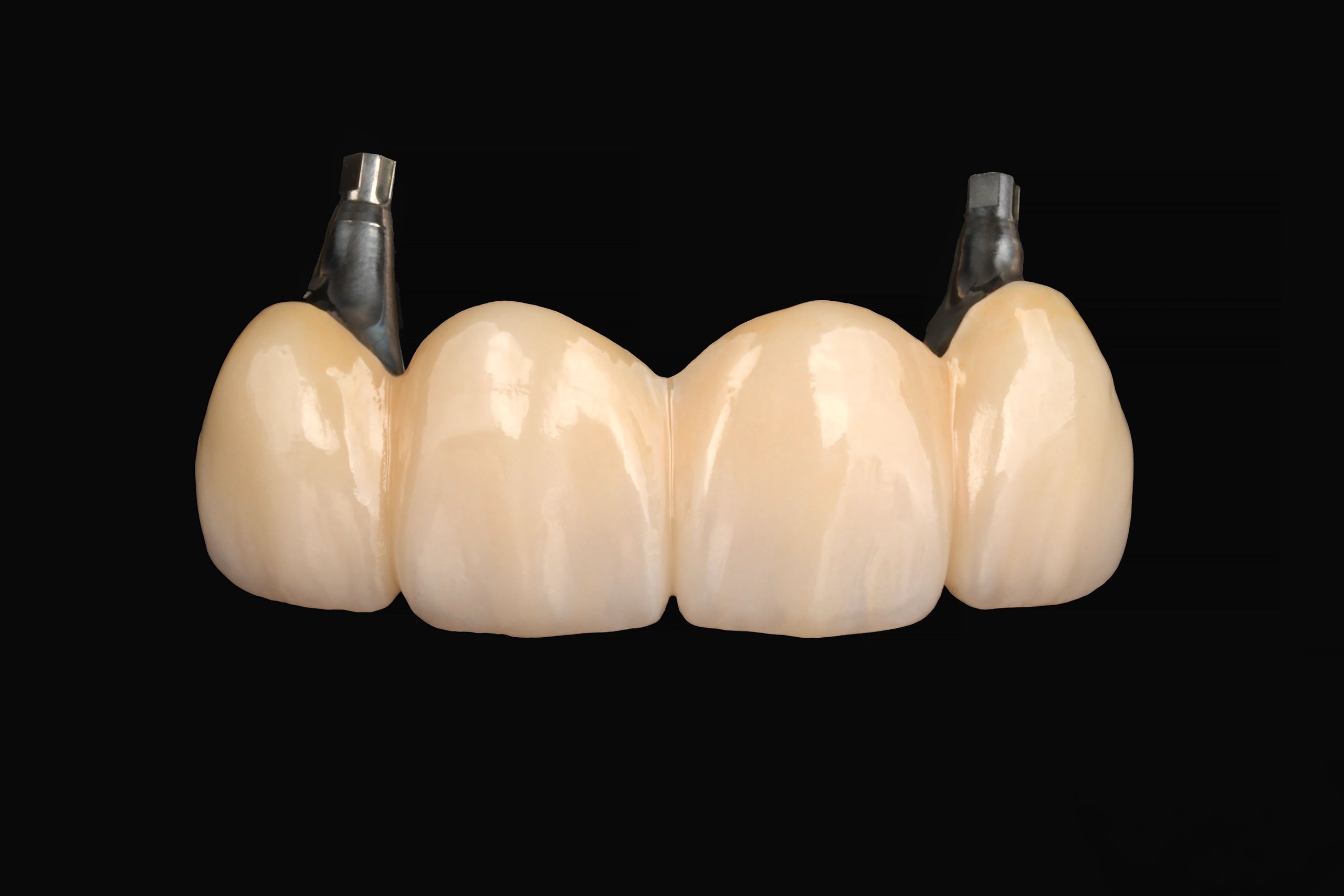 Close-up of a dental bridge with metal abutments on a black background.