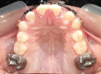 OnBRACE invented by Dr. Michael Johnston is manufactured by Specialty Appliances. Orthodontics