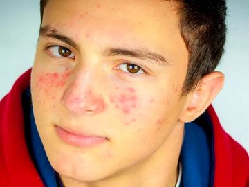 pele acneica, pontos negros, borbulhas, pele de adolescente, como melhorar a acne, aveiro, acne