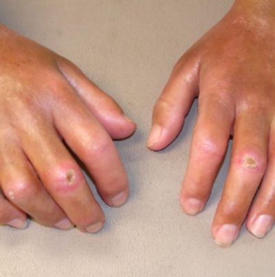 Swollen hands with skin lesions and discoloration.