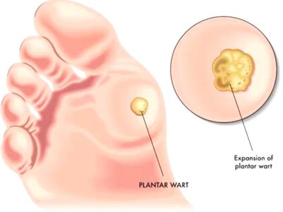 Plantar warts, foot doctor, feet, foot clinic, check-up, Christian Olivier Podiatrist, remove