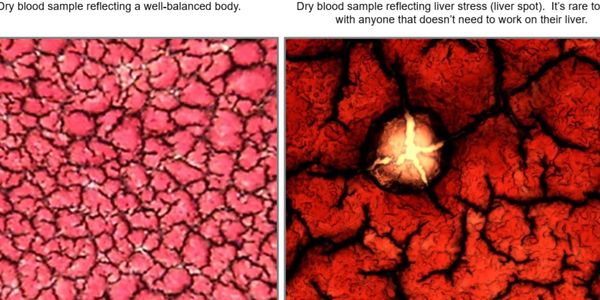 Nutrition blood cell analysis, dry blood cell analysis, dry blood nutrition,