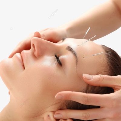 Woman receiving acupuncture treatment with needles on her forehead.