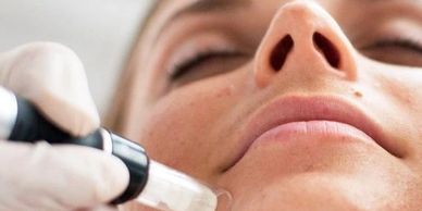 Boost your collagen with skinpen microneedling.
