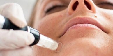 Boost your collagen with skinpen microneedling.