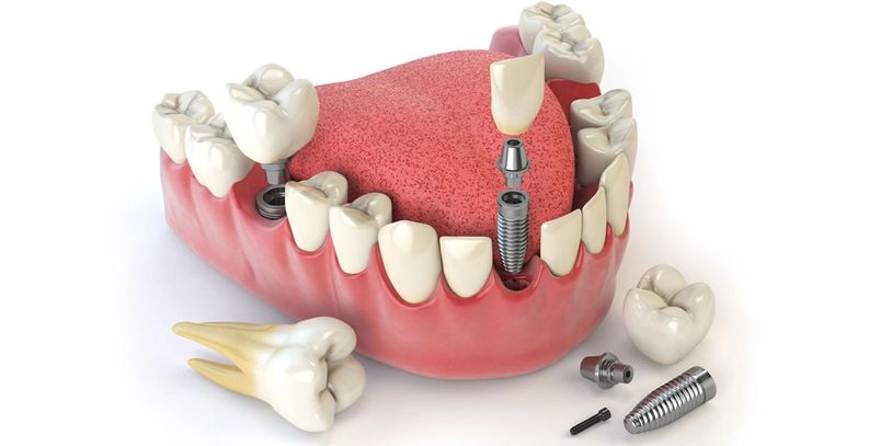 Implantes dentales