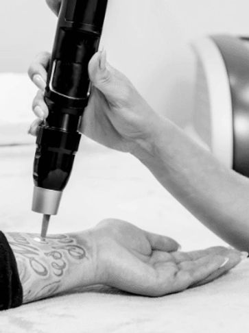 Laser Tattoo Removal Tattoo Bill's CLT Tattoo Removal Services
