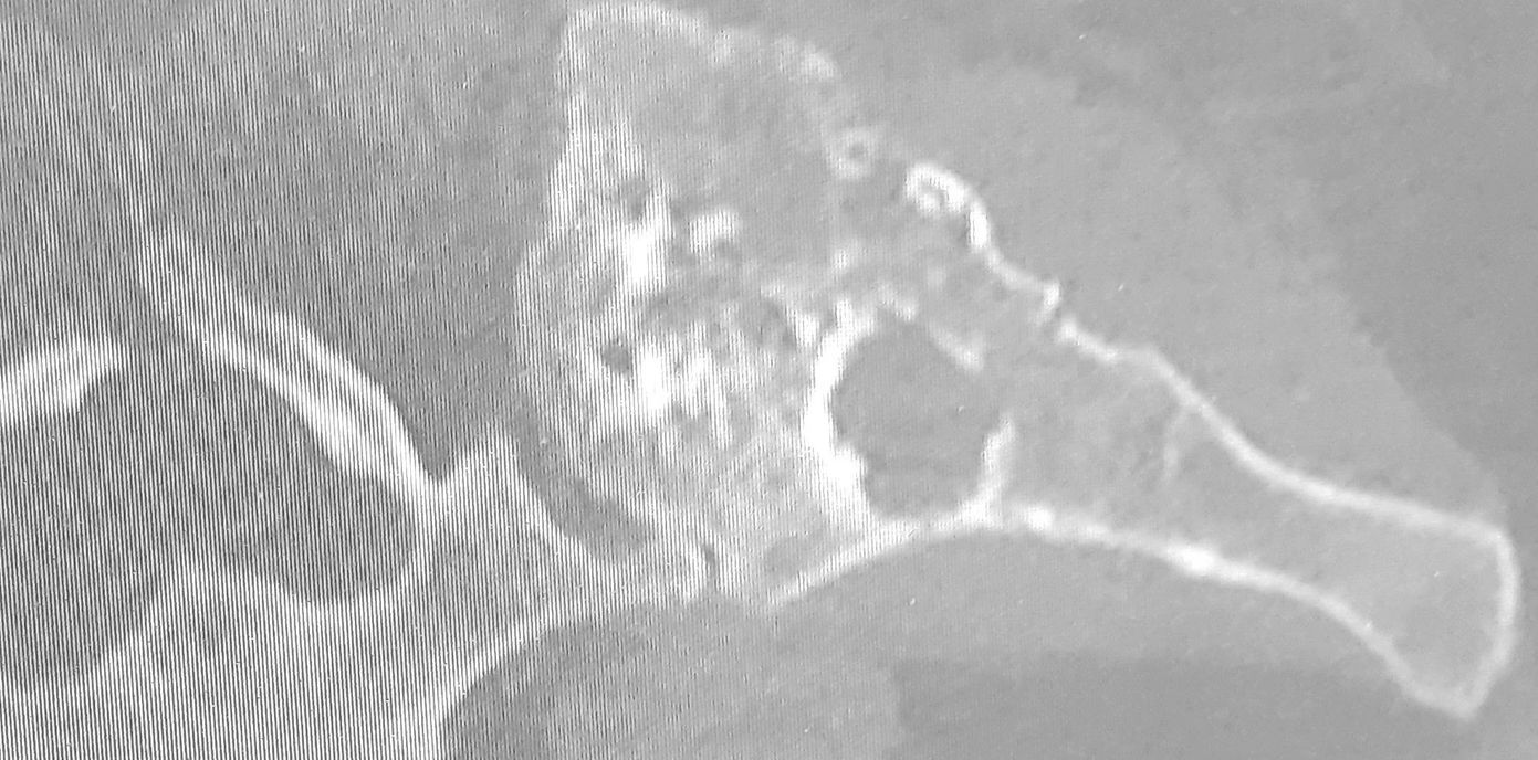 Malignant degeneration, iliac crest