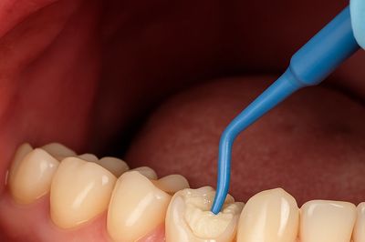 Dental filling procedure showing cavity cleaning and tooth restoration at Dental Care Center by Dr. 