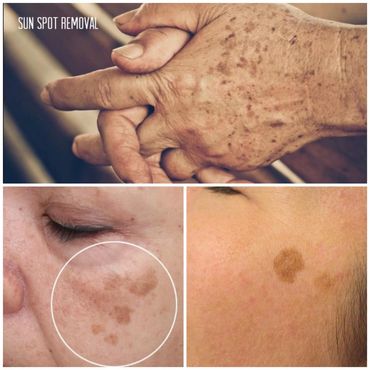 Sun or age spots removed