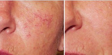 Thread veins on face easily removed 