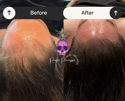 Before and after scalp micropigmentation showing fuller hair.