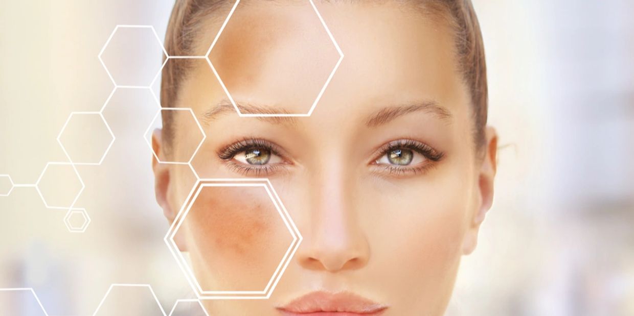 aging, age spots