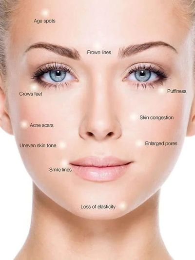 microneedling improves acne scars, enlarged pores, age spots, loss of elasticity