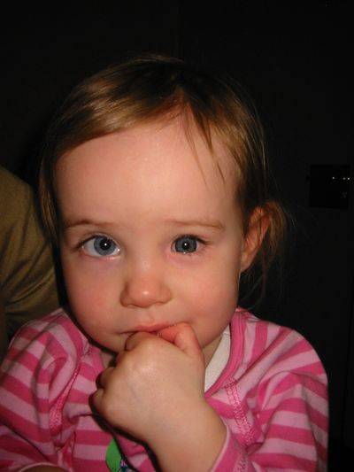 picture of young girl with left anophthalmia wearing artificial eye