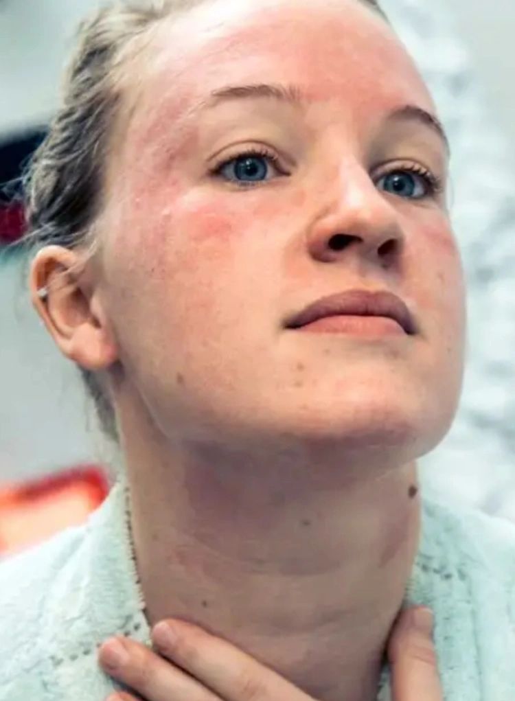 Symptoms of Vitamin B6 Deficiency