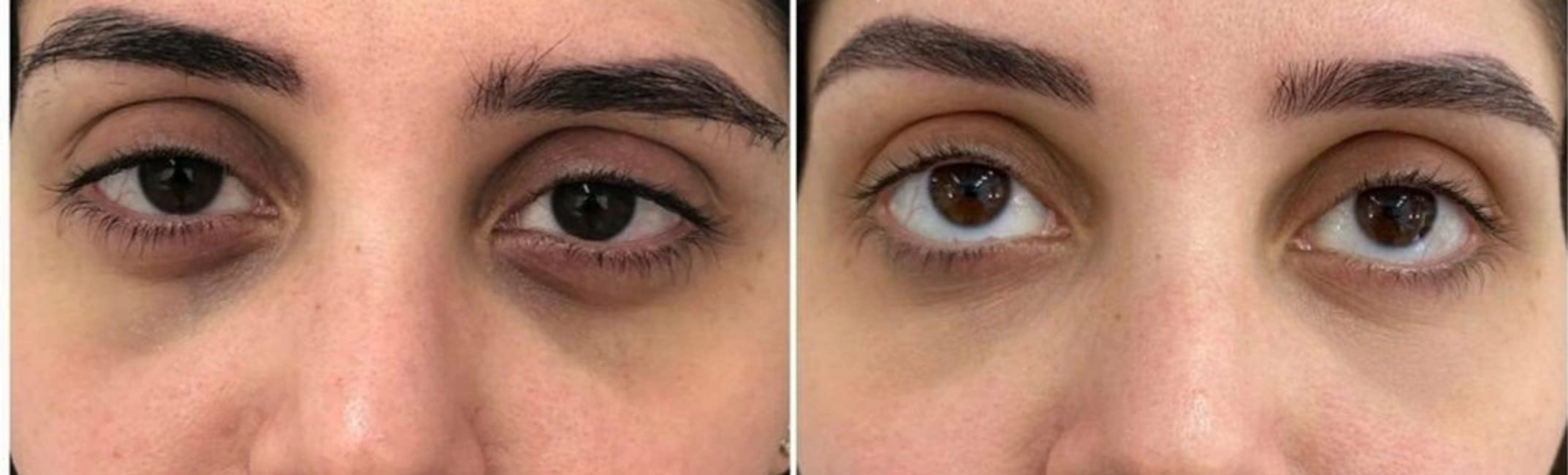 Permanent Under Eye Concealer Opulence Brows & Beauty Opulence