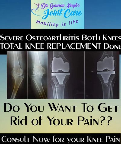 Total Knee Replacement