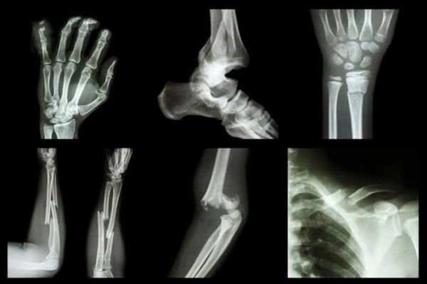 फ्रैक्चर ( FRACTURE ) कितने प्रकार के होते हैं? जानें कारण और ट्रीटमेंट