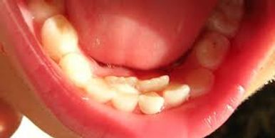 Over-retained Baby teeth