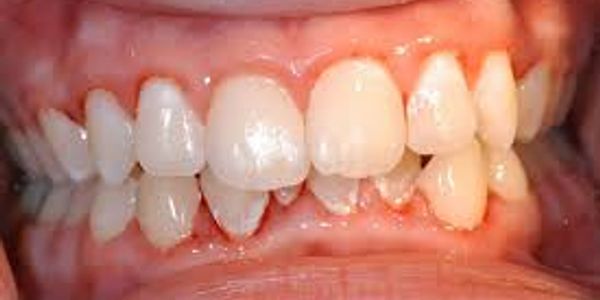 Plaque induce gingivitis attributed to poor oral hygiene.