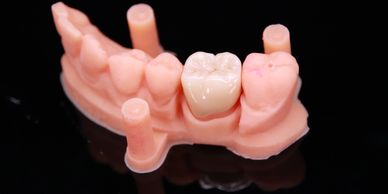 zirconia crown