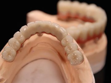 Custom CAD/CAM zirconia full-arch bridge with customized titanium bar bases on a stone model, suitab