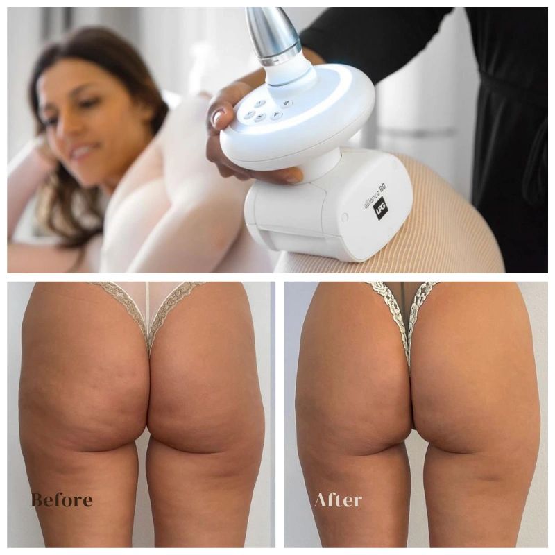 Endermologie2.png