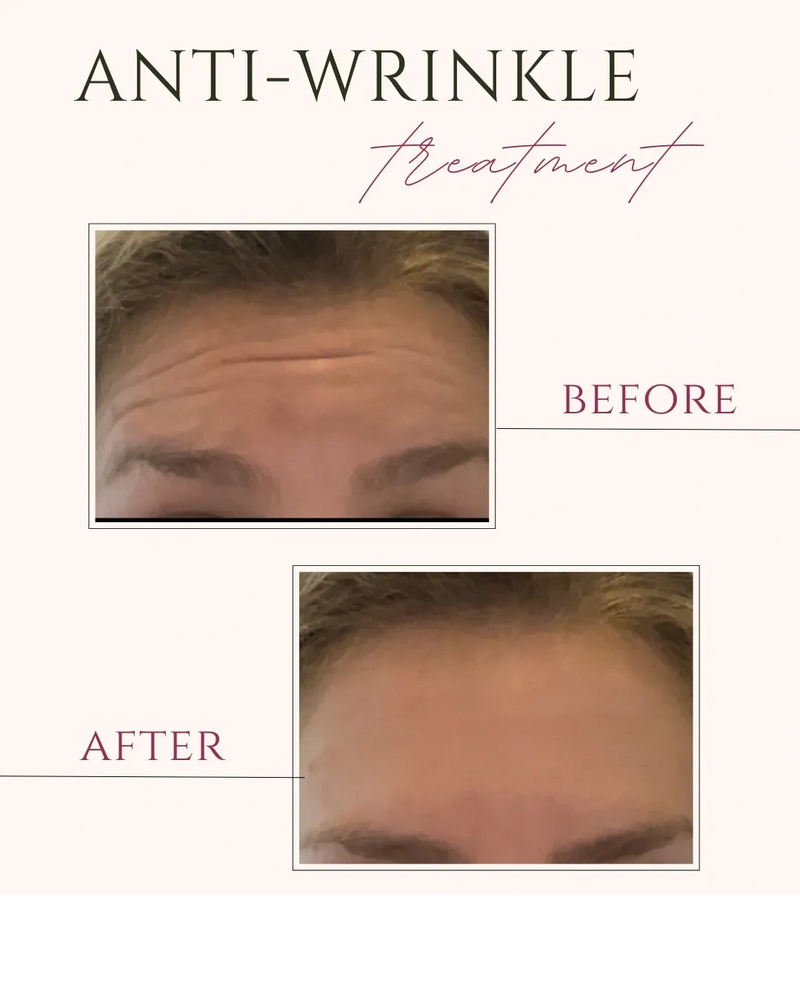 Image of before and after botox injection