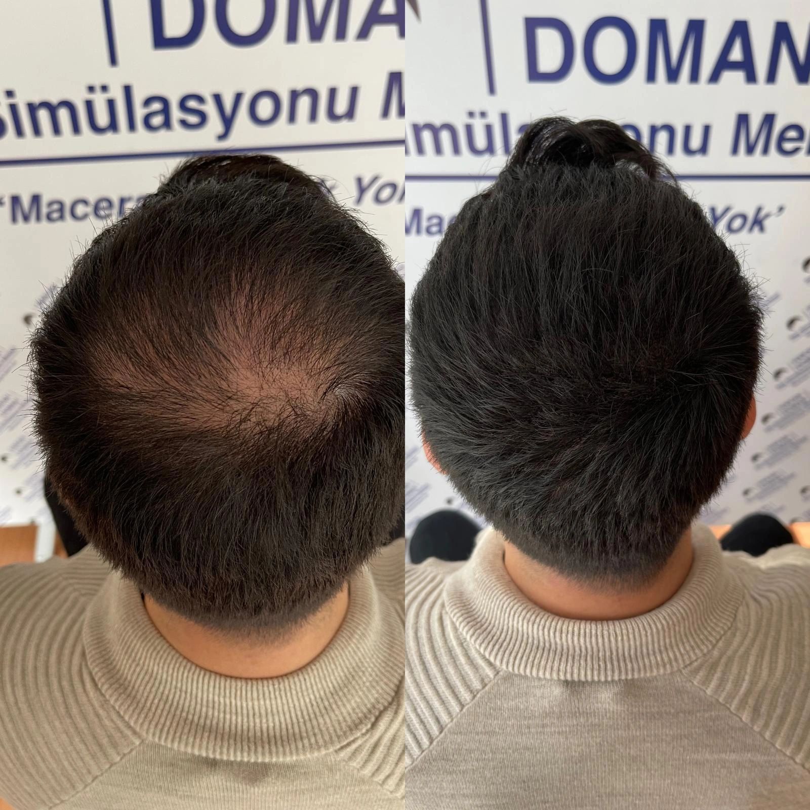 Erkek saç simülasyonu, smp, hakan doman