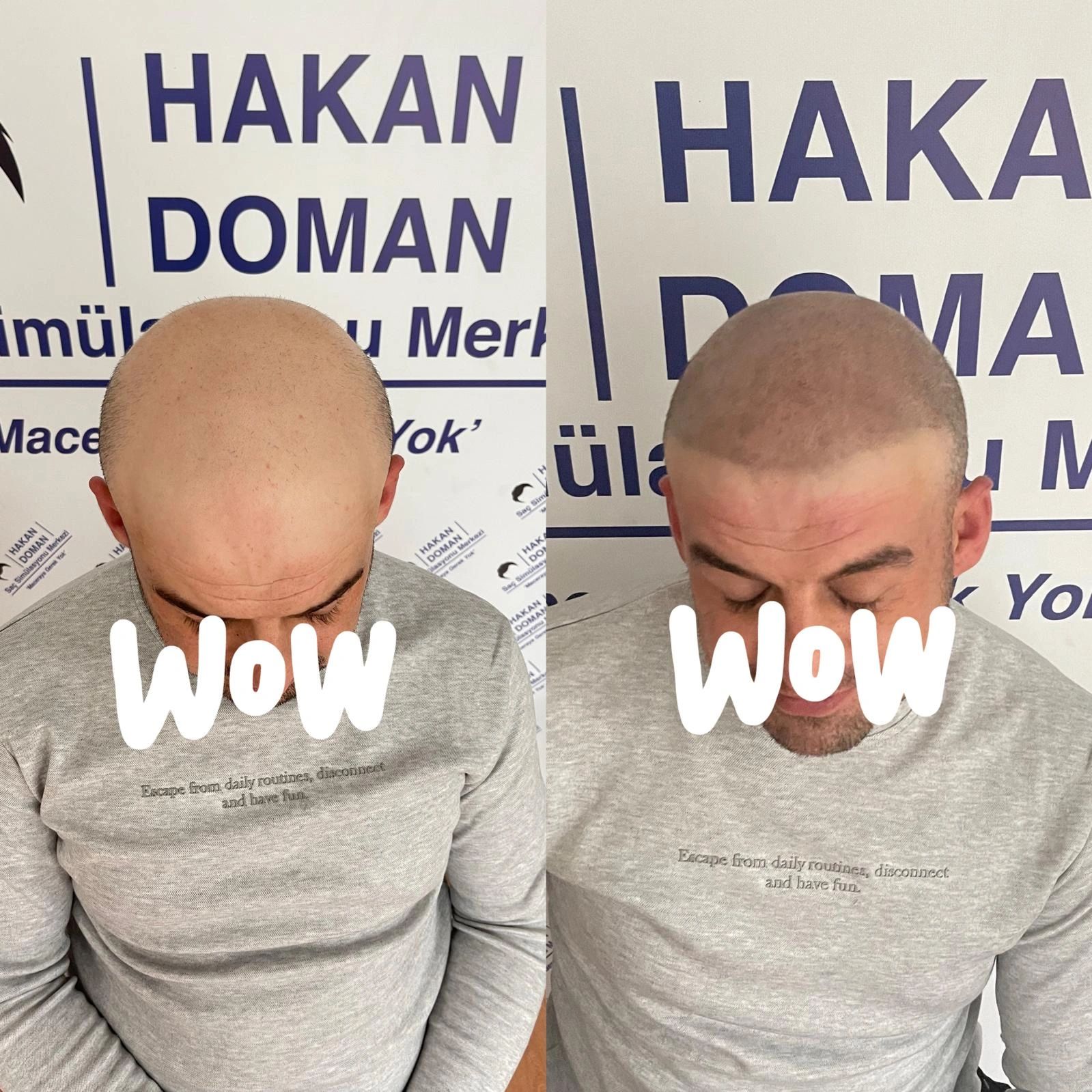 Erkek saç simülasyonu, smp, hakan doman